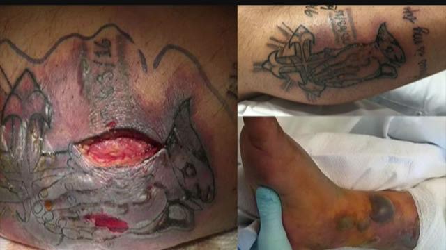 Man dies from vibrio after going into Gulf with fresh tattoo